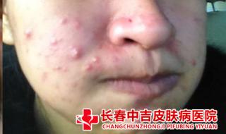 治疗痤疮最好的医院